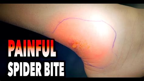 You may want to use an antihistamine such as Benadryl if you have swelling. . Painful spider bite